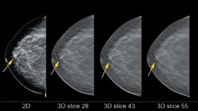 A suspicious area behind the nipple is resolved using tomosynthesis imaging (rightmost three images). Unlike the mass-like appearance on conventional mammography (left image), with tomosynthesis the normal structures creating the suspicious area on the conventional mammogram are identified. Those structures are normal vessels and ligaments in different regions of the breast (28, 43 and 55 mm above the breast platform).